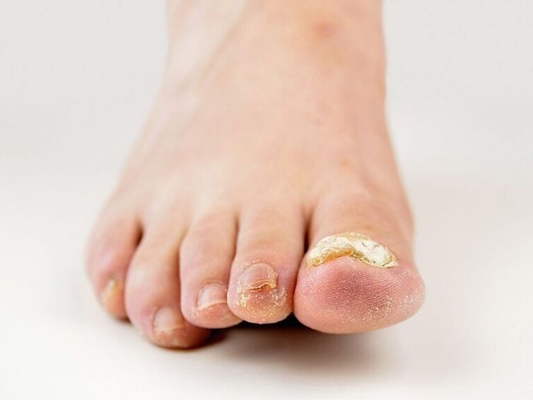 ciuperca hipertrofică a unghiilor de la picioare
